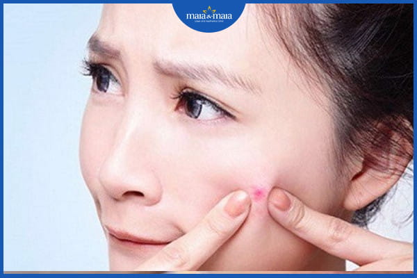 Mụn trứng cá có tự khỏi không? Làm sao để trị mụn trứng cá dứt điểm? 3 Mụn trứng cá có tự khỏi không