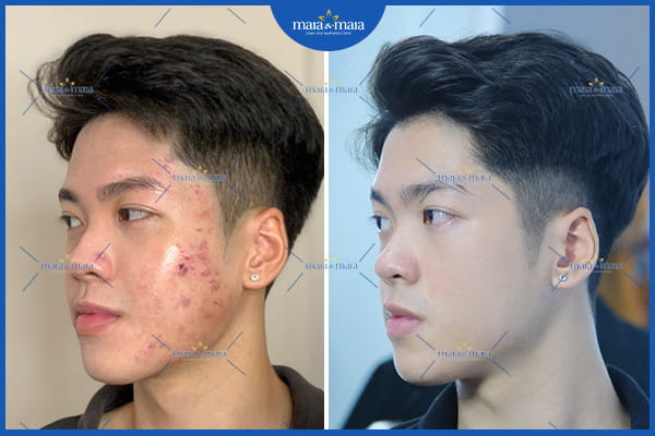 Mụn trứng cá ở nam giới tại sao lại khó điều trị? Cách khắc phục là gì? 2 nam giới nổi mụn trứng cá