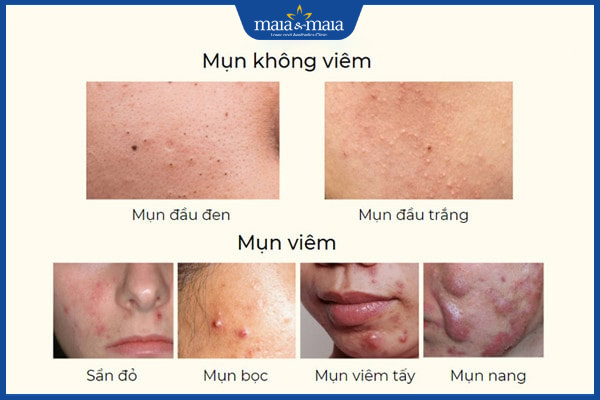 Mụn trứng cá L70 là gì? Điều trị mụn trứng cá ở đâu hiệu quả? 3 phân loại mụn trứng cá