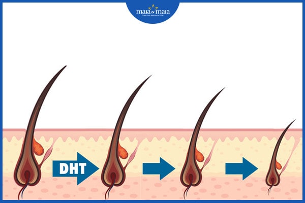 Rụng tóc ở tuổi dậy thì: nguyên nhân và cách khắc phục 2 rụng tóc ở tuổi dậy thì