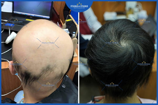 Rụng tóc ở tuổi dậy thì: nguyên nhân và cách khắc phục 4 rụng tóc ở tuổi dậy thì