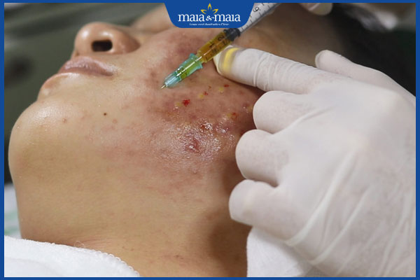 tiêm thuốc trị mụn