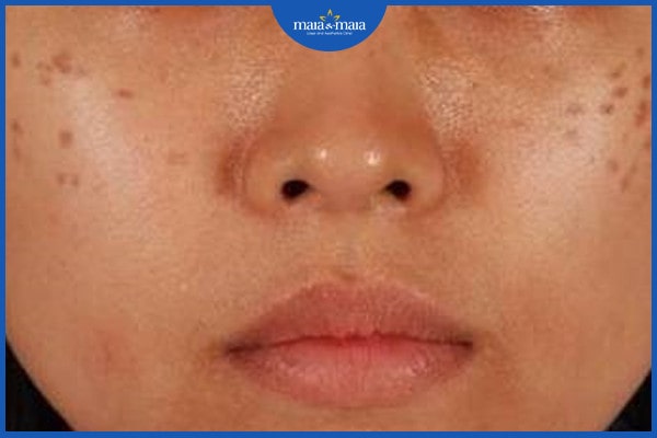 Bớt sắc tố Hori là gì? Nguyên nhân và phương pháp điều trị hiệu quả 2 Bớt sắc tố Hori