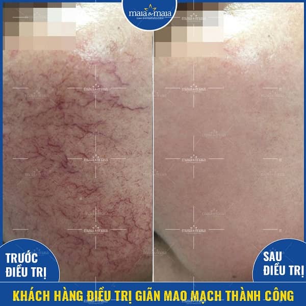 Giãn mao mạch có chữa được không? Những cách để phòng tránh 2 giãn mao mạch có chữa được không
