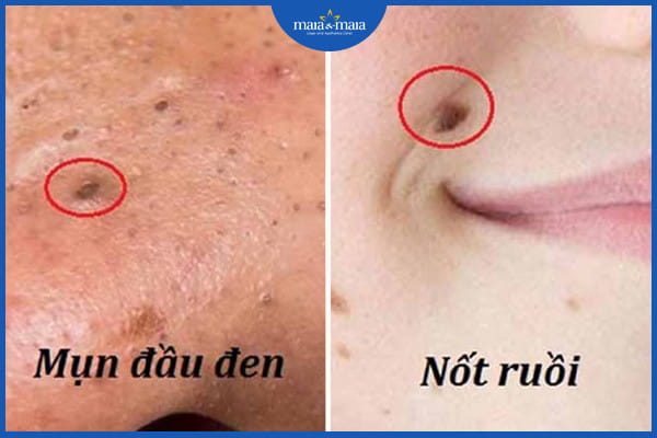 Sự thật về mụn có thành nốt ruồi không? 2 Mụn có thành nốt ruồi không