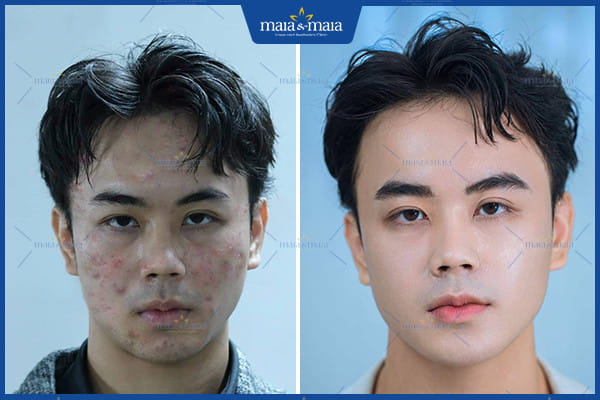 Giải đáp thắc mắc: 30 tuổi vẫn bị mụn nguyên nhân do đâu? 3 30 tuổi vẫn bị mụn