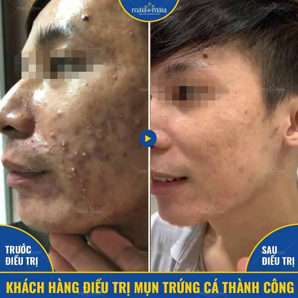 Mụn ở từng độ tuổi: nguyên nhân gì và cách khắc phục? 2 mụn ở từng độ tuổi