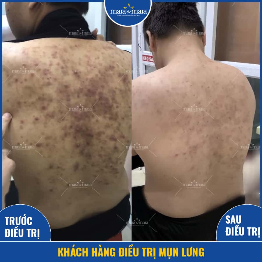 Mụn ở từng độ tuổi: nguyên nhân gì và cách khắc phục? 3 mụn ở từng độ tuổi