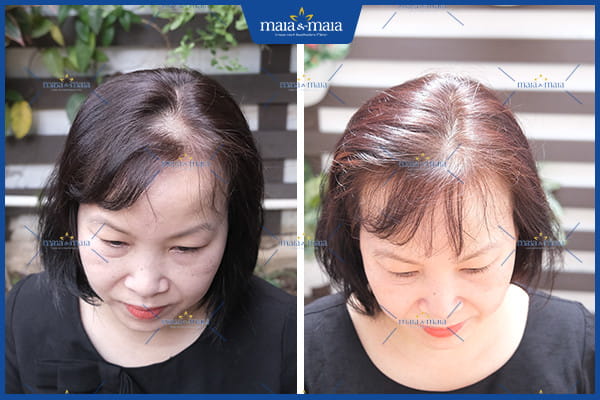 Rụng tóc kiểu hói nữ: nguyên nhân và các phương pháp điều trị 2 rụng tóc hỏi kiểu nữ