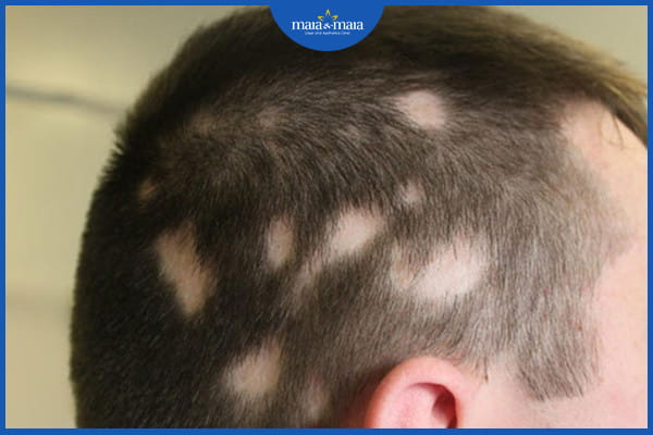 Tóc rụng theo mảng vào mùa đông - nguyên nhân là gì? 2 tóc rụng theo mảng vào mùa đông