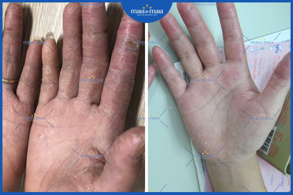 Viêm da cơ địa có bị lây không? 3 viêm da cơ địa có bị lây không