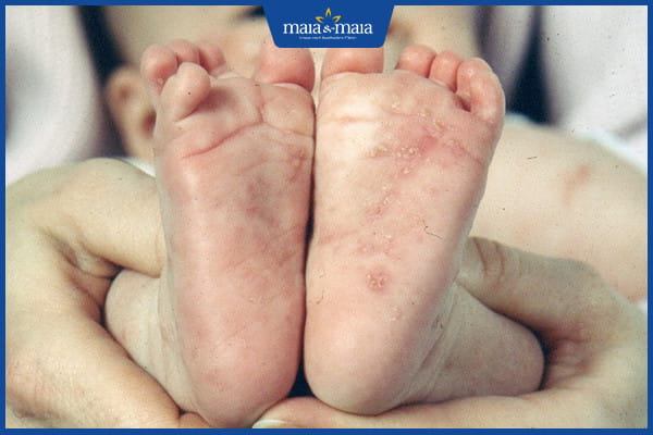 Chữa bệnh ghẻ ở trẻ em thế nào? 2 chữa bệnh ghẻ ở trẻ em