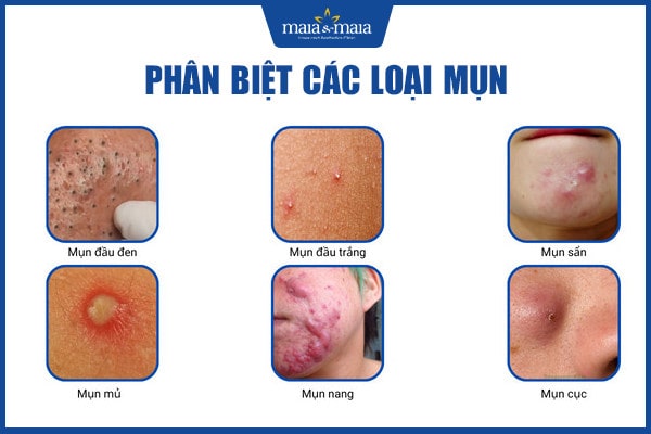Có nên đi spa trị mụn tuổi dậy thì? 2 Có nên đi spa trị mụn tuổi dậy thì