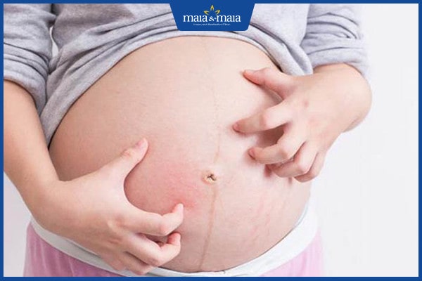 Mề đay khi mang thai và sau sinh: Những điều cần biết 2 mề đay khi mang thai và sau sinh