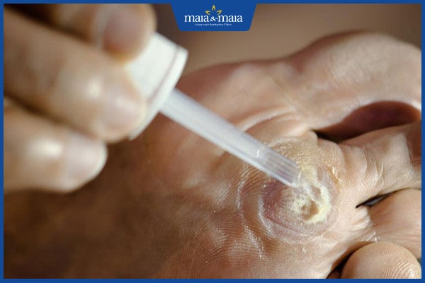 Hướng dẫn chọn thuốc trị mụn cóc hiệu quả và an toàn 3 thuốc trị mụn cóc