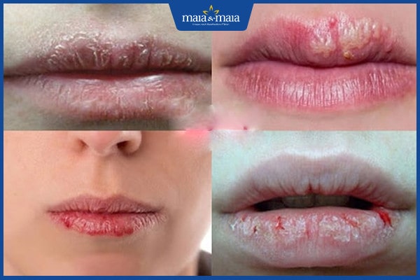 Cách điều trị viêm môi chuẩn y khoa từ bác sĩ da liễu 2 điều trị viêm môi