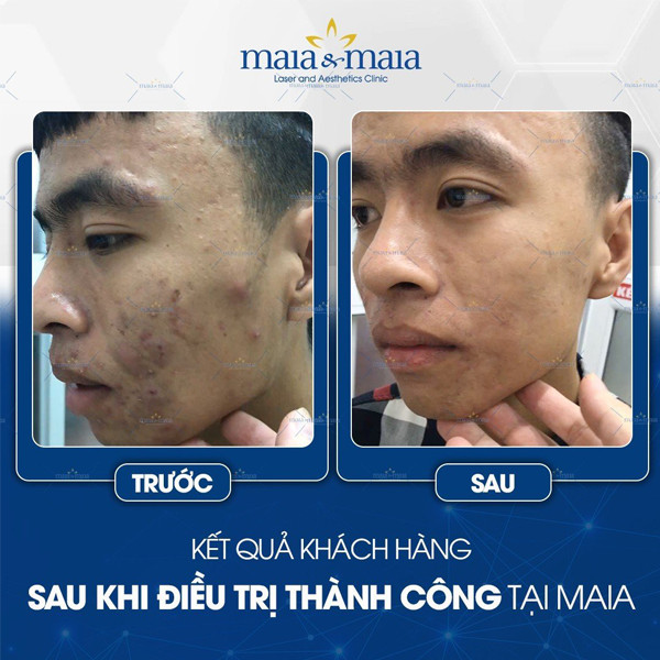 tri mun 10