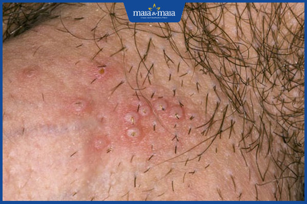 Công nghệ Maitrix Gene điều trị sùi mào gà hiệu quả tới 99% 3 Tất cả các trường hợp mắc sùi mào gà đều có thể điều trị bằng công nghệ Maitrix Gene