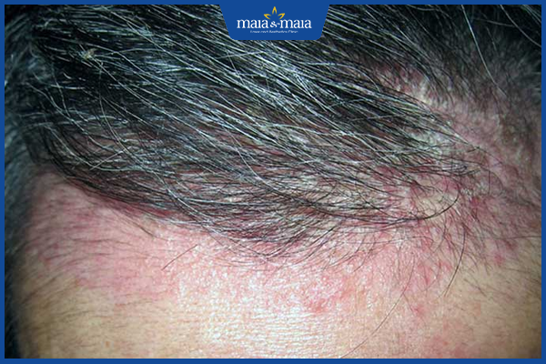 Viêm da dầu là gì? Địa trị điều trị viêm da dầu triệt để 3 Da dầu ở ngay trên trán, vị trí gần chân tóc