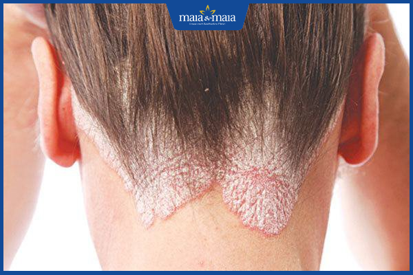 Viêm da dầu là gì? Địa trị điều trị viêm da dầu triệt để 4 Viêm da dầu ở vị trí chân tóc sau gáy