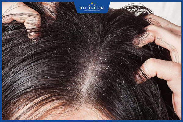 Viêm da dầu là gì? Địa trị điều trị viêm da dầu triệt để 10 Tránh gãi ngứa sau điều trị viêm da dầu
