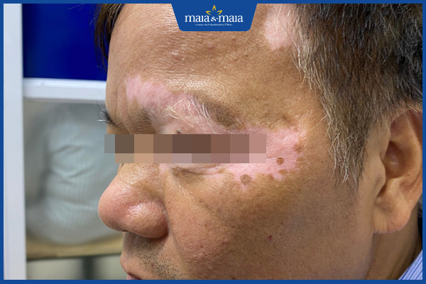 Công nghệ Maitrix Vigo có thể thực hiện đối với các trường hợp bạch biến