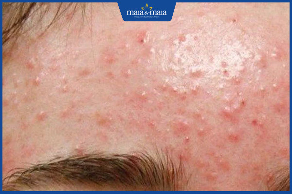 CÔNG NGHỆ MAITRIX ACNE ĐẬP TAN NỖI ÁM ẢNH VÌ MỤN 