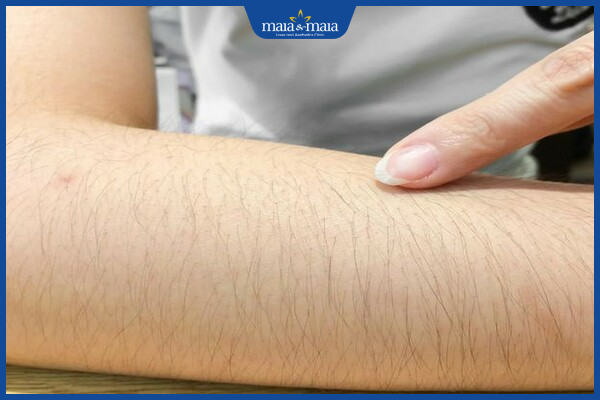 Công nghệ Maitrix DiPL giải pháp triệt lông vĩnh viễn hoàn hảo 4 CÔNG NGHỆ MAITRIX DiPL - GIẢI PHÁP HOÀN HẢO ĐỂ TRIỆT LÔNG VĨNH VIỄN