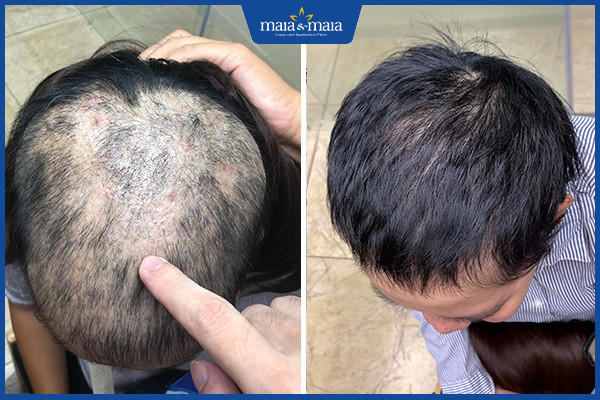 Công nghệ Maitrix Hair: Rụng tóc, hói đầu không còn là nỗi lo 3 Công nghệ Maitrix Hair áp dụng điều trị cho những trường hợp rụng tóc, hói đầu