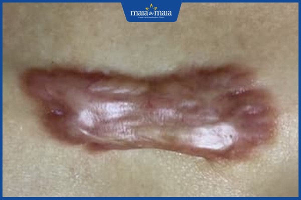 Công nghệ Maitrix Scar xoá sổ hoàn toàn sẹo lồi, sẹo xấu 3 Công nghệ Maitrix Scar được áp dụng thực hiện với trường hợp sẹo lồi, sẹo xấu