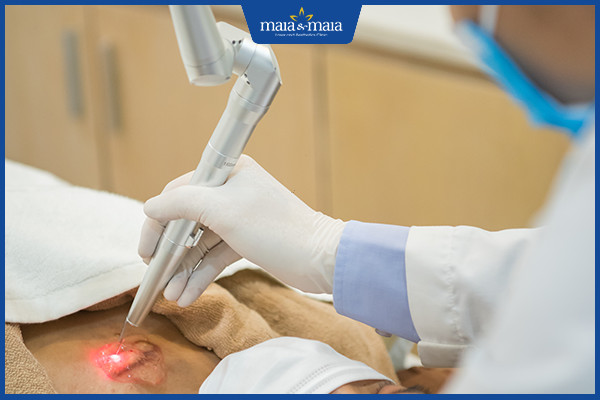 Công nghệ Maitrix Scar xoá sổ hoàn toàn sẹo lồi, sẹo xấu 2 Công nghệ Maitrix Scar áp dụng trong điều trị sẹo lồi, sẹo xấu