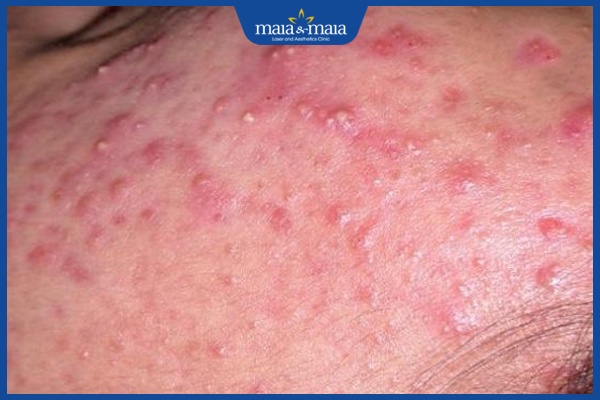 Mụn trứng cá: Cơ chế hình thành, nguyên nhân và cách điều trị 2 Mụn trứng cá là dạng viêm nang lông tuyến bã