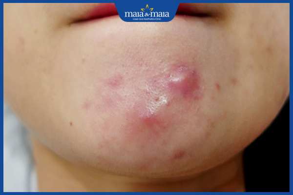 Mụn trứng cá: Cơ chế hình thành, nguyên nhân và cách điều trị 5 Mụn trứng cá ở cằm