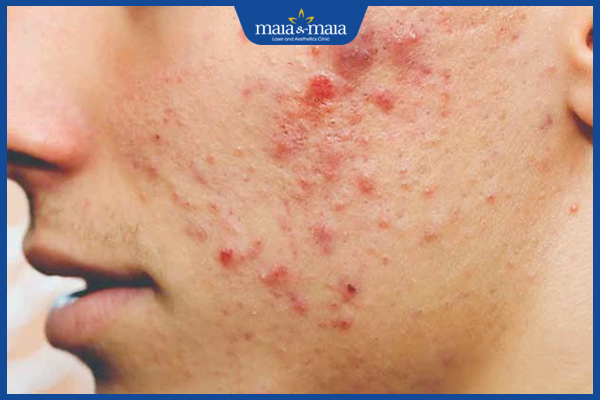 Mụn trứng cá: Cơ chế hình thành, nguyên nhân và cách điều trị 6 Má cũng là vị trí rất hay mọc mụn trứng cá