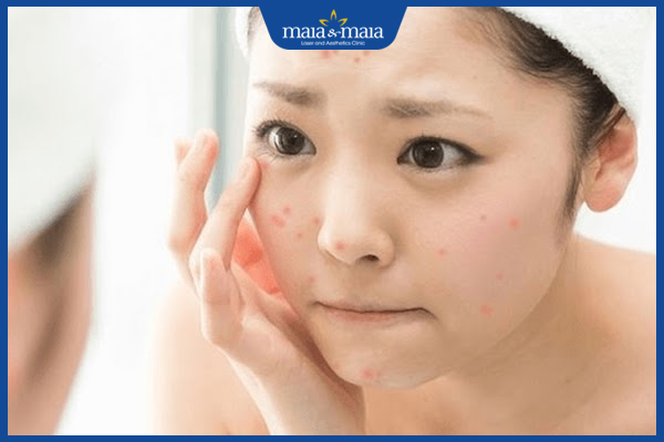 Mụn trứng cá: Cơ chế hình thành, nguyên nhân và cách điều trị 8 Khi thấy mụn trứng cá trở nên trầm trọng nên thăm khám bác sĩ