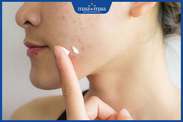 Mụn trứng cá: Cơ chế hình thành, nguyên nhân và cách điều trị 9 Mụn trứng cá ở mức độ nhẹ chỉ cần bôi thuốc