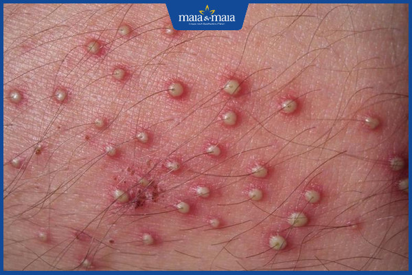 Viêm da: Dấu hiệu nhận biết, phân loại và cách điều trị dứt điểm 10 Viêm nang lông