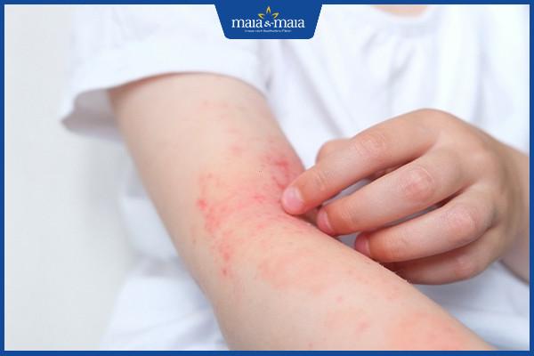Viêm da: Dấu hiệu nhận biết, phân loại và cách điều trị dứt điểm 3 Viêm da xuất hiện ở mọi vị trí trên cơ thể