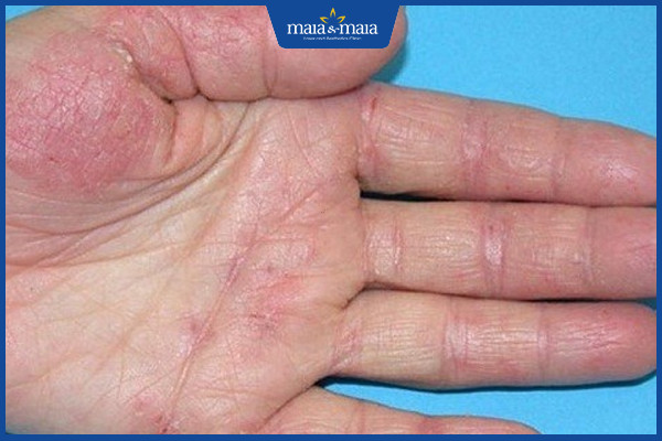 Viêm da: Dấu hiệu nhận biết, phân loại và cách điều trị dứt điểm 8 Viêm da tiếp xúc