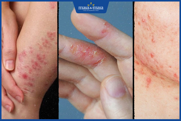 Viêm da: Dấu hiệu nhận biết, phân loại và cách điều trị dứt điểm 2 Bệnh viêm da gây cảm giác ngứa ngáy, khó chịu