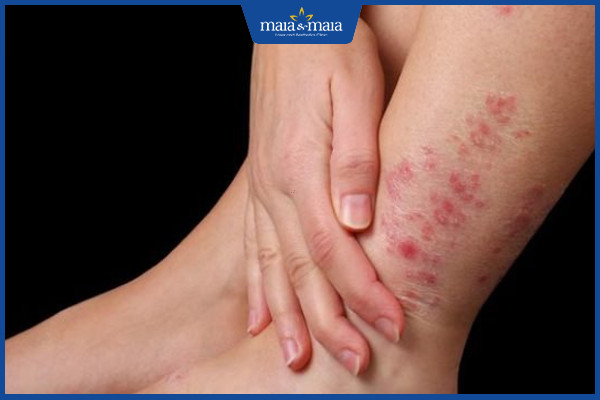 Viêm da: Dấu hiệu nhận biết, phân loại và cách điều trị dứt điểm 16 Không điều trị kịp thời có thể gây biến chứng nguy hiểm