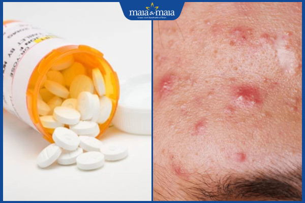 Những sai lầm khi điều trị mụn trứng cá 4 dùng thuốc chứa corticoid