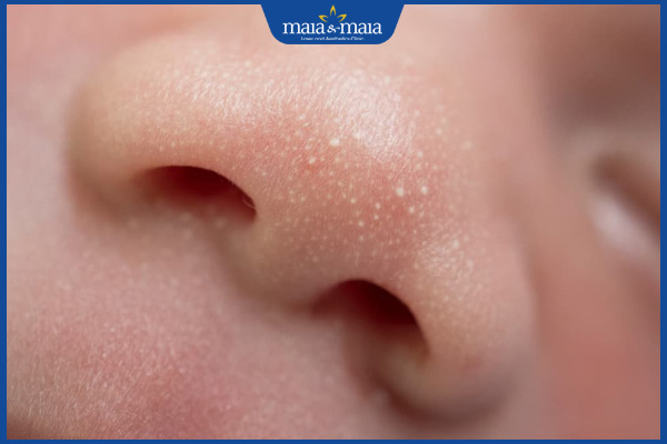 hình ảnh mụn sữa ở trẻ