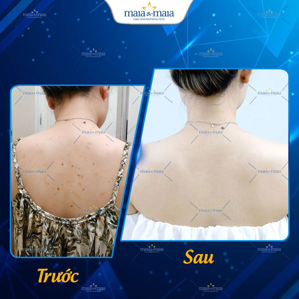 khách điều trị mụn trứng cá ở lưng