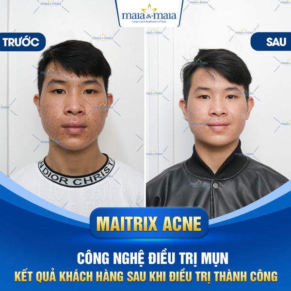 khách điều trị mụn trứng cá