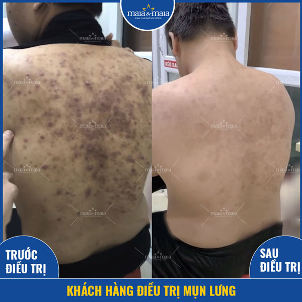 khách hàng trị mụn trứng cá ở lưng