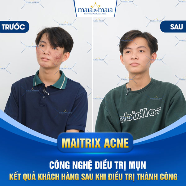 khách hàng trị mụn trứng cá