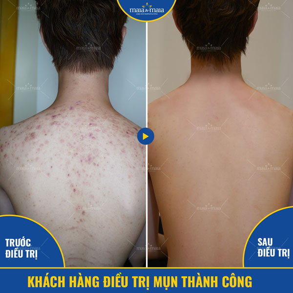 khách trị mụn trứng cá ở lưng