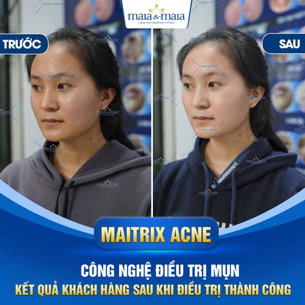 khách trị mụn trứng cá