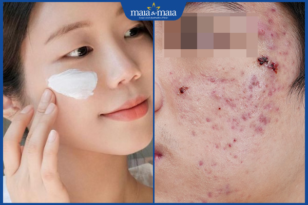 Những sai lầm khi điều trị mụn trứng cá 3 không làm sạch da đúng cách